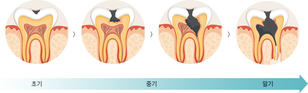 초기 ▶ 중기 ▶ 말기