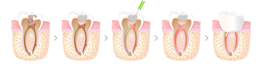 치아신경치료 단계