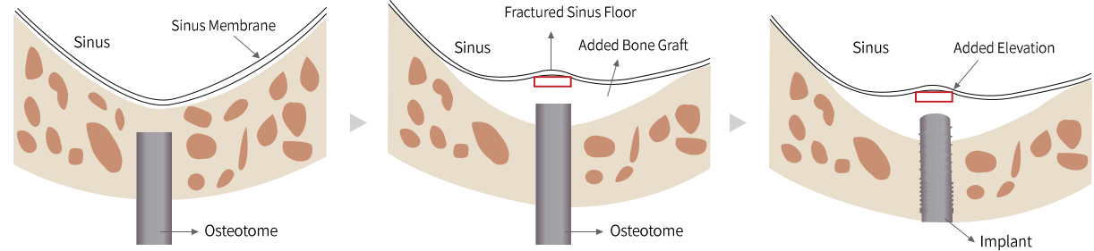 상악동 하방 골 높이가 5mm 이상인 경우